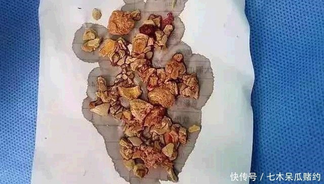 婴儿|5个月婴儿患“肾结石”,都是辅食惹的祸,医生很多家庭还在喂