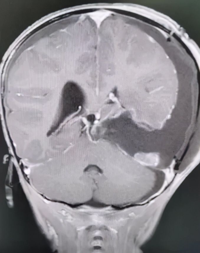 折翼天使们|2岁就查出肿瘤！这些让人心疼的折翼天使们，后来怎么样了？