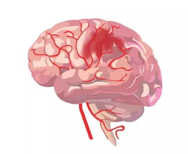 脑卒中|太形象！12张动图详解脑卒中