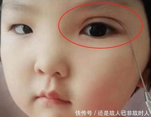 现状|妈妈想让娃变美,亲手为6岁女儿“割双眼皮”,孩子现状让人心疼