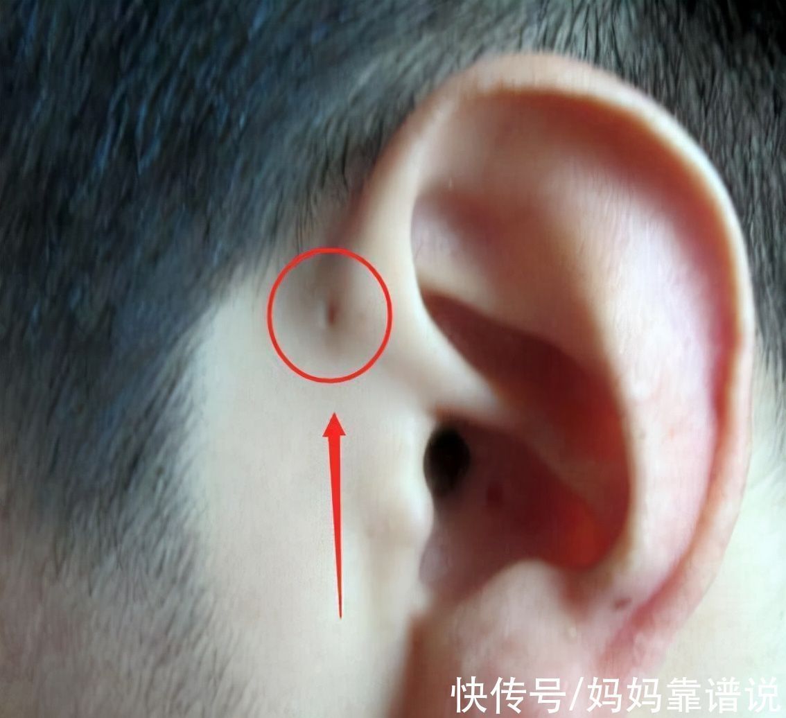 小孔|3岁男童耳边长“聪明孔”,奶奶用手挤,却害了孩子
