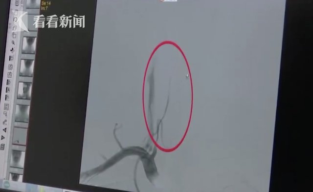 头晕|按摩后狂吐男子紧急就医 医生：这个位置别乱按
