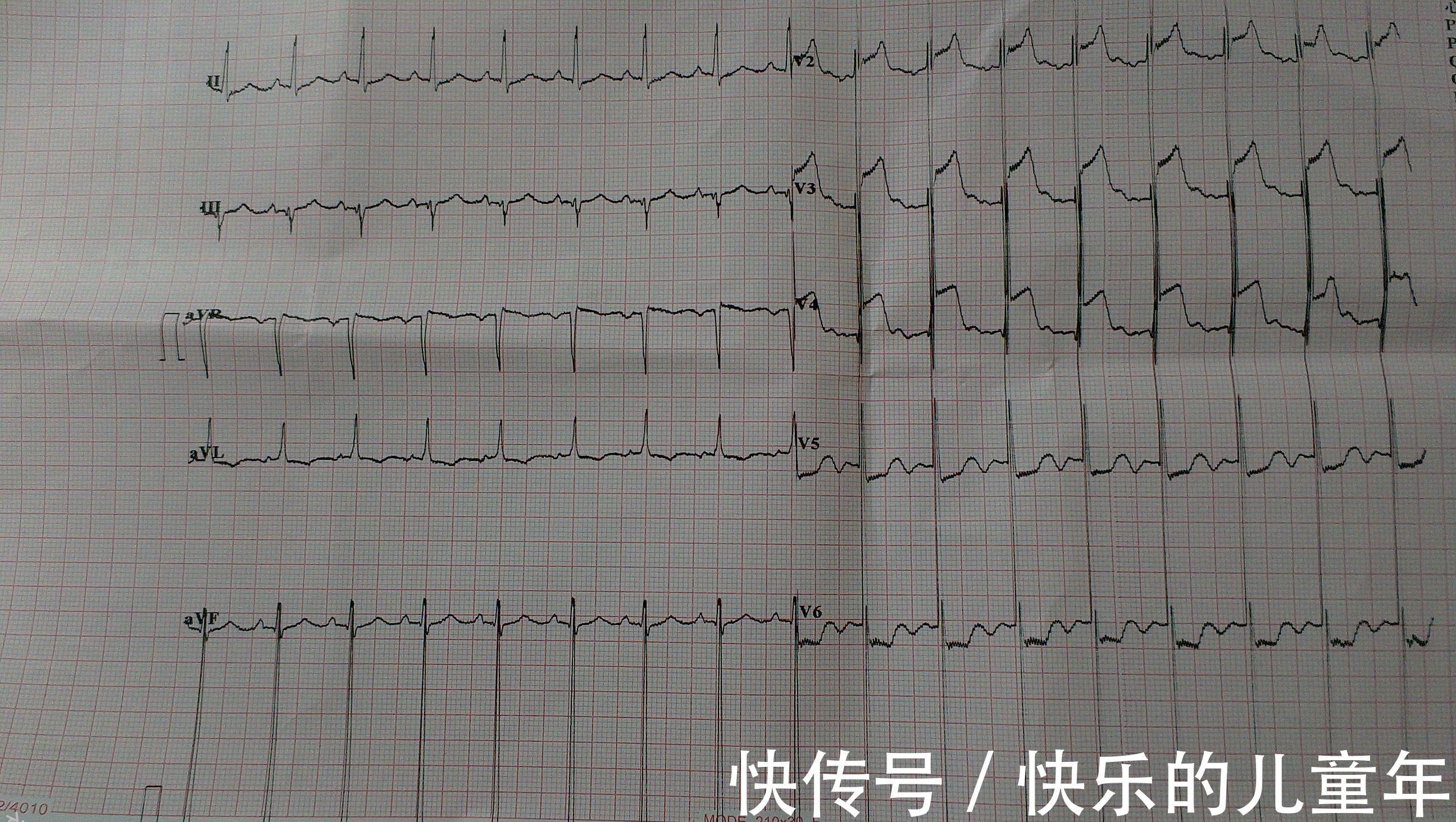 预兆|心肌梗死发生前有没有“预兆”，很多人说没有，其实是你没在意！