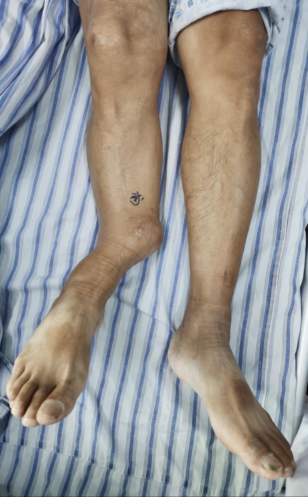 犀利！14年的长短腿一朝治愈|【三水人医】专科技术 | 陈旧性骨折