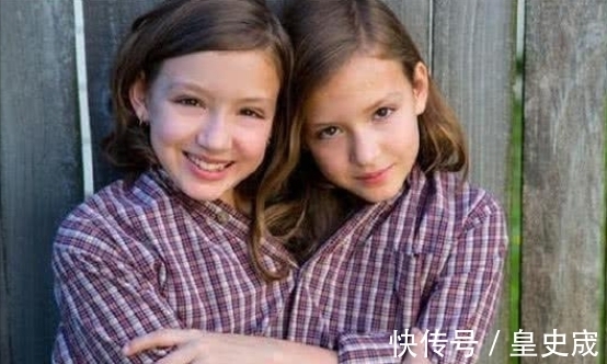 去世|“连体人”中一人不幸去世,另一人会怎么样?看完算是明白了