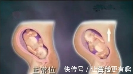 孕晚期|请问大家有什么好的方法使臀位变成头位呀?33+了?