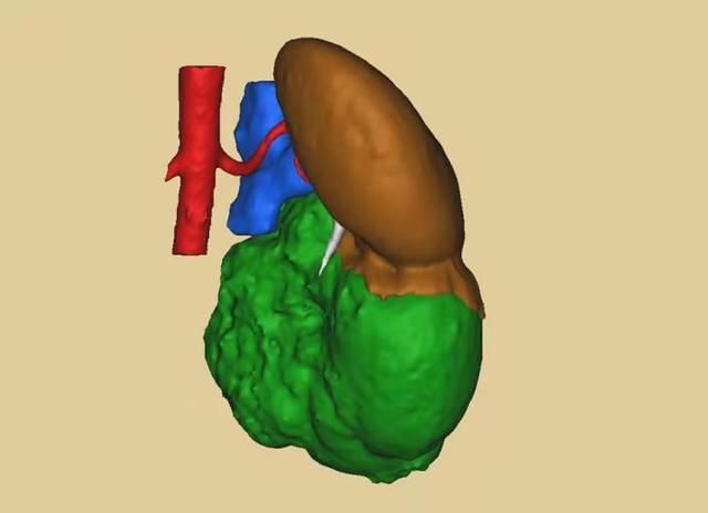 肾脏|肾囊肿两年疯涨1.5倍，艰难组合手术后成功摘瘤保肾