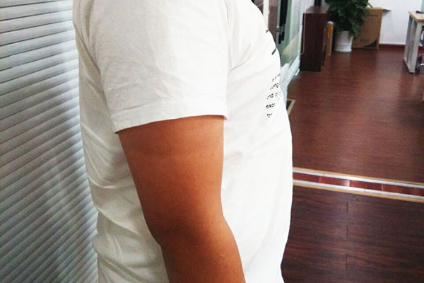 肝癌|身体有癌,肚子先知腹部的异常表现,值得我们关注