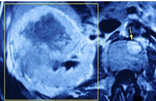 复发|癌症明明治好了，为啥还复发转移主治医生不轻易说出的真相