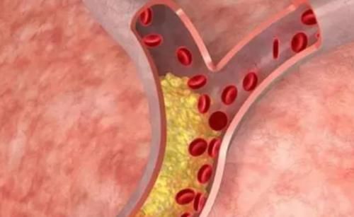 动脉|体检查出颈动脉斑块,一年后复查,斑块消失了,他是如何做到的