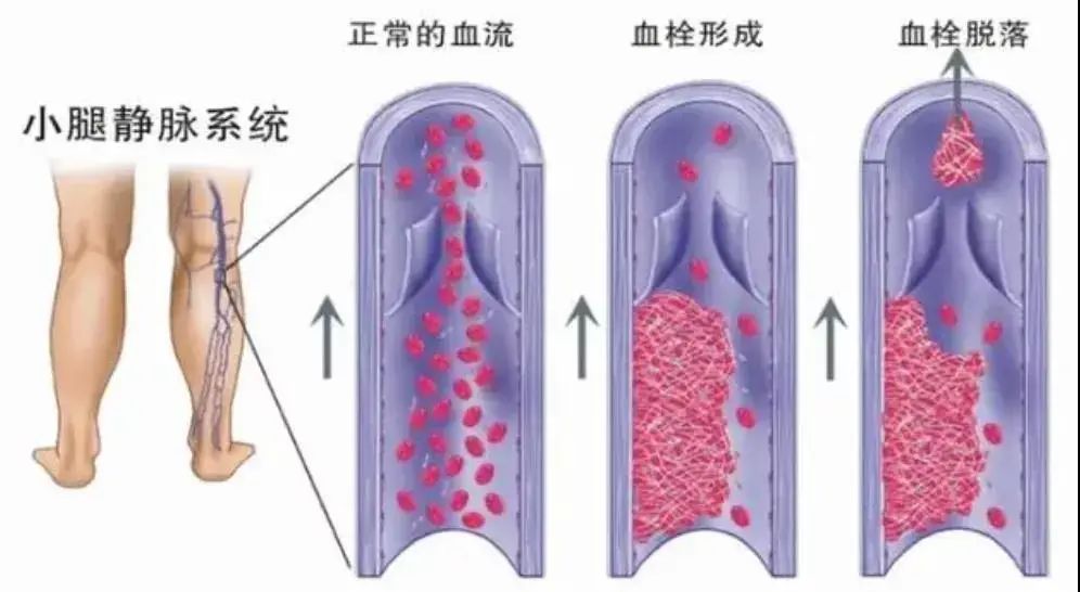 沉寂的杀手——深静脉血栓|健康科普 | 血栓