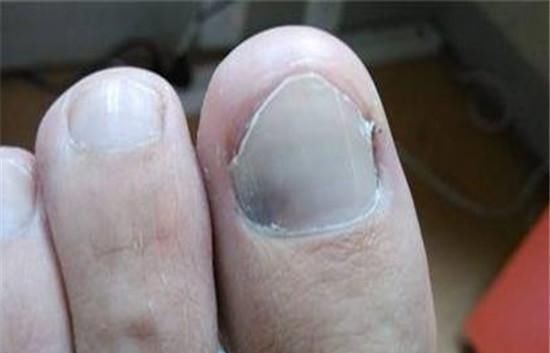脚趾|糖尿病“来临”时，“脚上”会有3处亮红灯，若一个都没有恭喜！