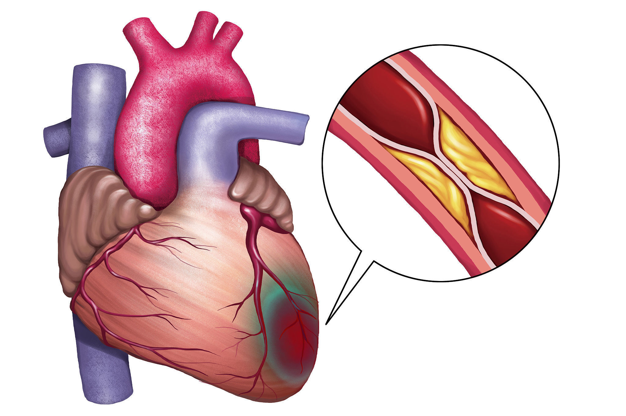 症状|除了胸疼，这三处疼痛也可能与心梗有关