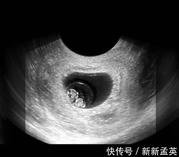 胚胎|胎儿从卵泡到性别形成,17张图片清晰诠释,男宝女宝看得很清楚