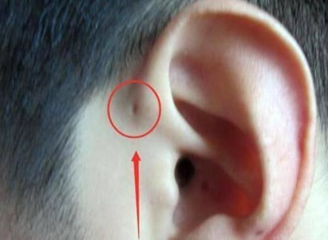 家长|为什么有的新生儿耳朵有“小孔”?医生一般不说,家长心中要有数