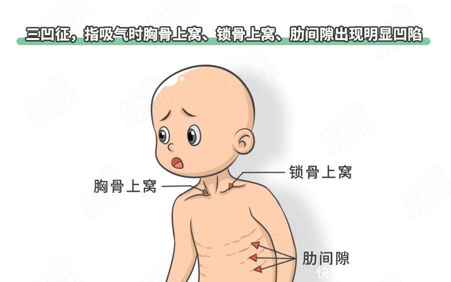 糖皮质激素|娃求救,你看不出来?咳嗽似狗叫+3大典型症状,有1个就危险
