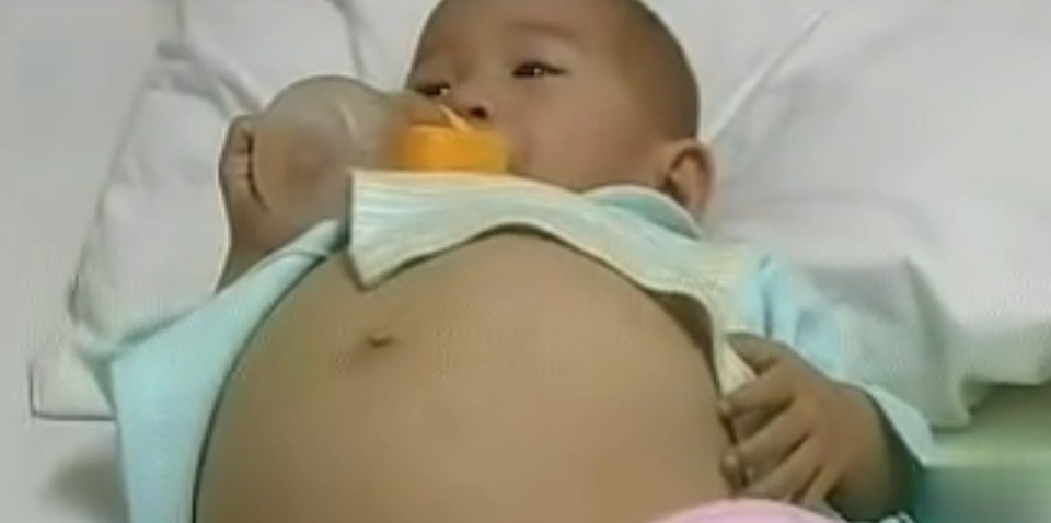 肚子|一岁半女婴意外“怀孕”，体内被查出死胎，手术途中吓坏医生