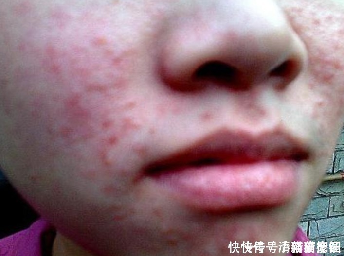 清洁|脸上痘痘反复长很困恼别怕!教你5个方法,帮你快速清除痘痘!