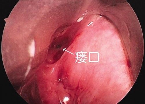 脖子|女学生颈部反复感染难愈 兰大一院医生妙手除病根