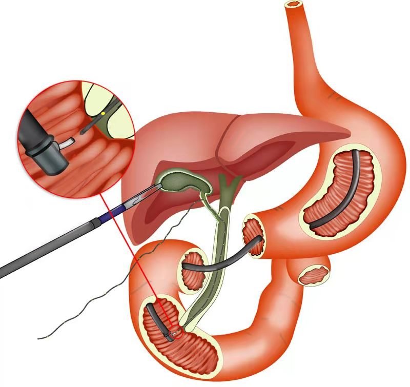 胆道|肚子疼就挺一挺，76岁阿姨挺“出事”了
