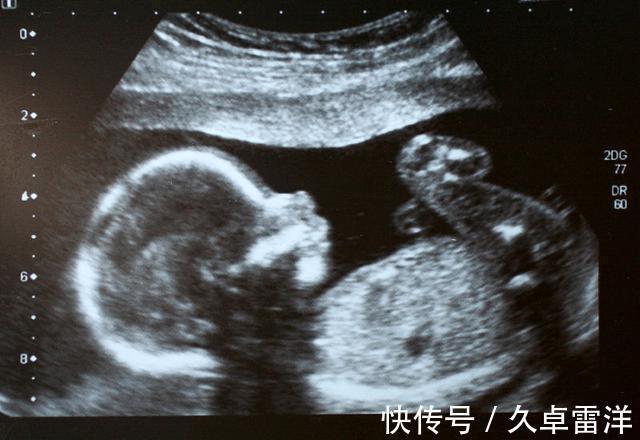 孩子|每次产检结果正常,孩子生出后发现畸形,医院需要负责吗