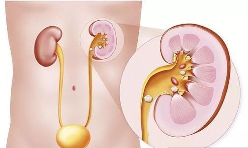 金铃子|中医治“结石病”的基本方!用我一片真心,换你一身无石