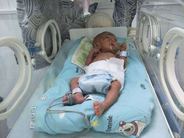 姚甜甜|早产双胞胎姐妹遭遇罕见病,出生时不足两斤,腿还没爸爸手指粗