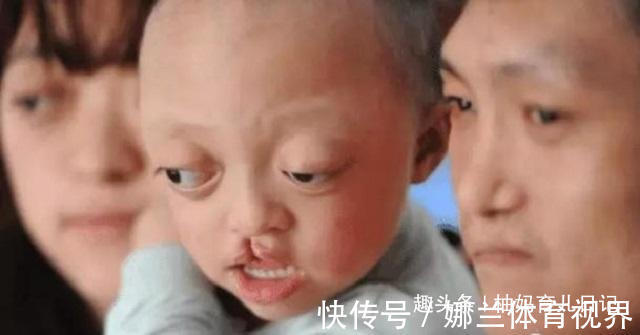 狭颅症|有种遗传叫“屏蔽优点”,三代人的缺点聚一起,丑的别具一格