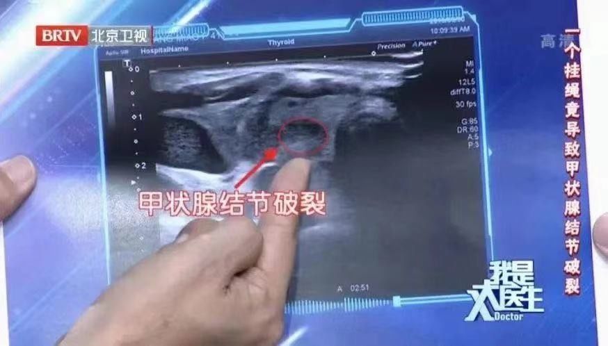 血流|2年没复查，息肉变成癌！B超报告里出现“这些字眼”可能就危险了，别等严重时才后悔