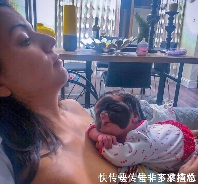 胎记|7个月婴儿脸上因巨大黑色胎记爆红!像带着“蝙蝠侠”面具!
