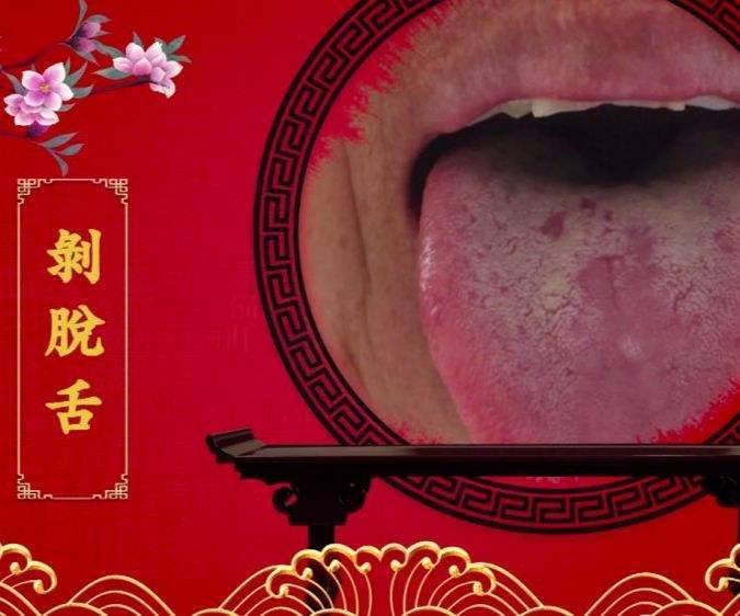 地图舌|一张治小孩“地图舌”的方子!地图舌到底咋回事,此文讲清楚