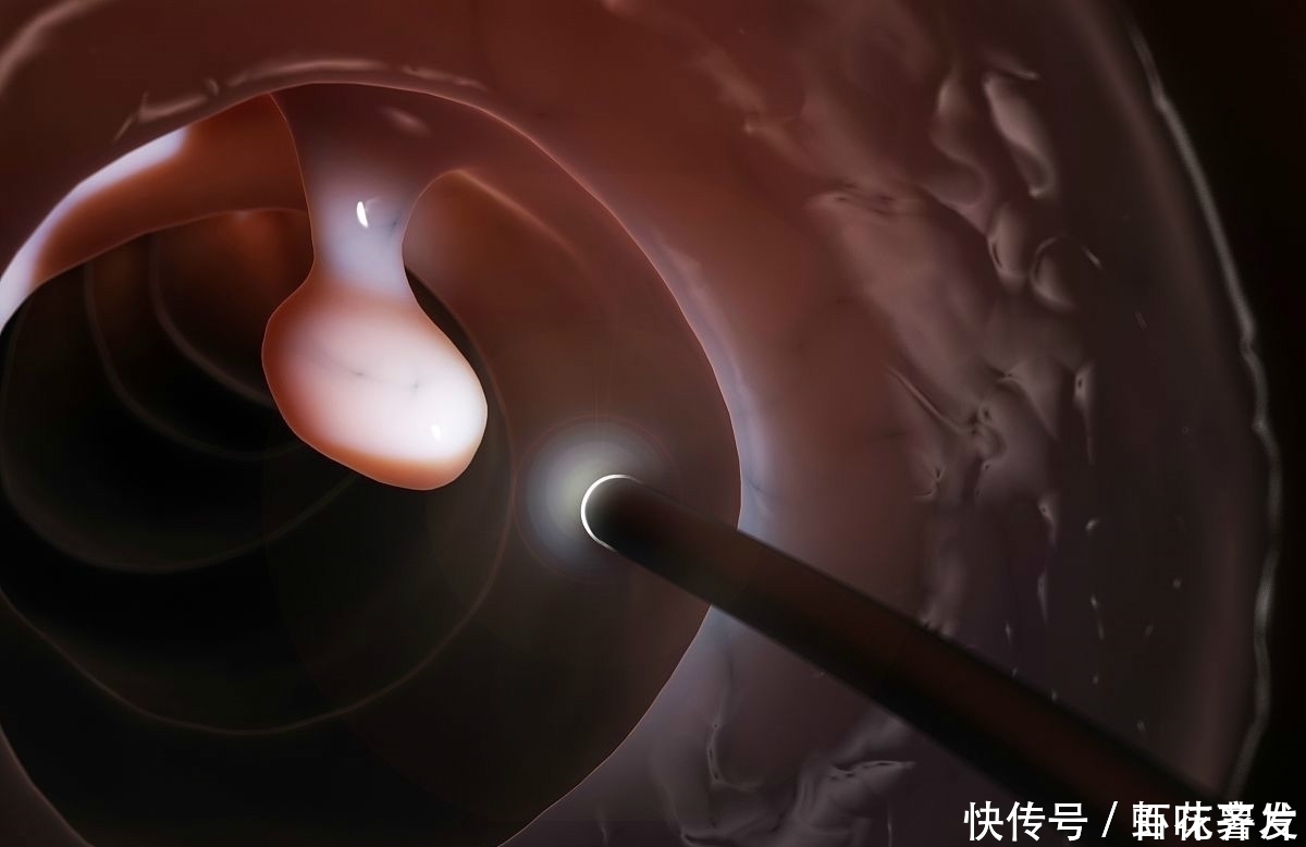 手术切除|两种息肉一定要及时切除,一拖再拖会变成恶性肿瘤