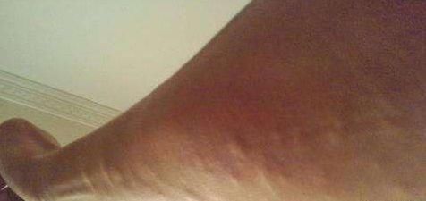 脂肪瘤|治“脂肪瘤”的小方子来了偷学来的险招,治疙瘩不痛、不痒