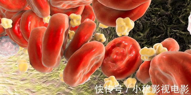 心脑血管疾病|54岁女子脑梗离世,烟酒不沾,医生叹息:一把年纪,此事早该控制