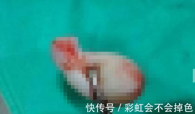 月子|女子坐月子掉下一块肉,医院检查后,女子泪目医生无语