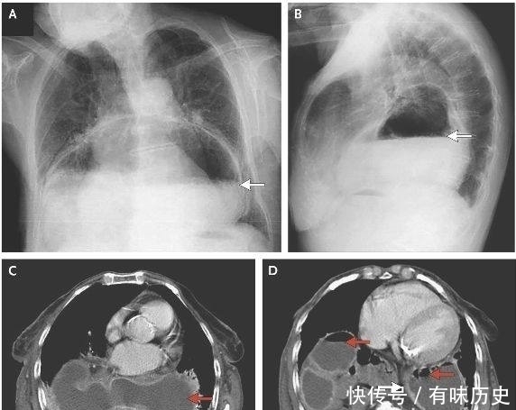食管裂孔疝|爸妈要好好照顾婴儿，不然有各种问题出现，看到最后一张图明白了