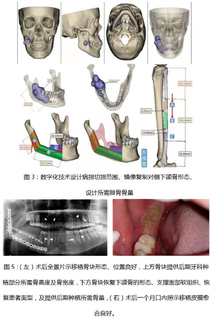 种植|市中心医院口腔科成功完成一例下颌骨成釉细胞瘤扩大切除后双层腓骨移植联合牙种植手术