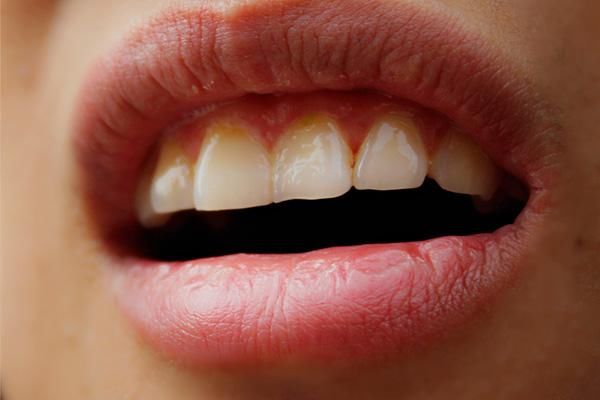 冲牙器|抠牙为什么会这么臭?原来都是它在作怪.....