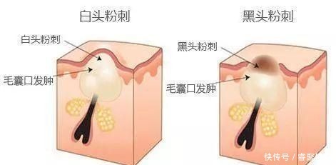 水杨酸|闭口、黑头、痘痘、脂肪粒……终于分清它们是什么了