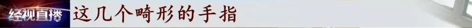 胎儿|宝宝出生缺失四根手指，家长质疑孕检误诊，涉事医院回复：不存在
