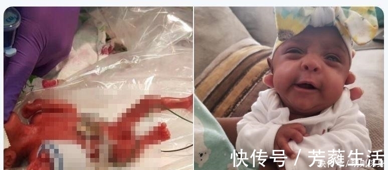 优质蛋白|全球最小“婴儿”体重245克,比手掌还小,6个月过去了现状如何?