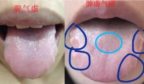 香砂六君丸|身上没劲肚子胀,大便不成型,齿痕舌脾虚中成药有哪些