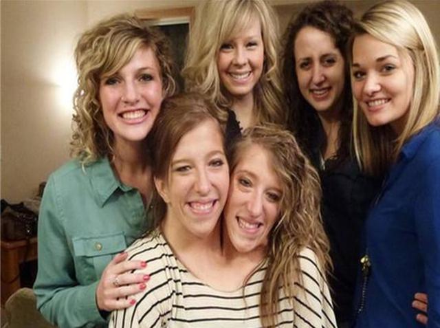 宠物|31年前的连体婴,医生曾断言活不过十天,如今活成了这样