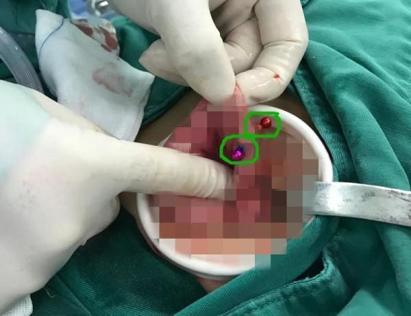 急诊科医生|2岁男孩肠子破了8处,竟是这东西惹的祸!很多人家里都有