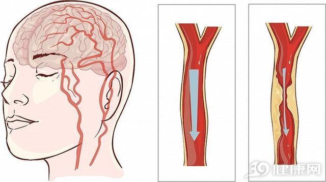 血脉|硬了的血管,如何“软”回来中医手把手教你3个方法