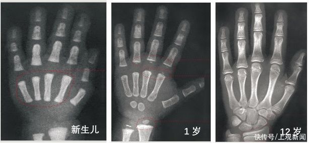 骨龄|我家宝宝不长个怎么办？这几类检查了解一下