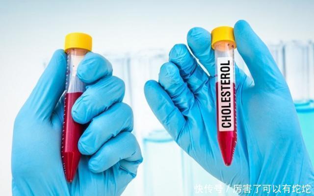 血脂|52岁王先生半年甘油三酯从5.1降到1.7,医生:或因坚持做了3件事