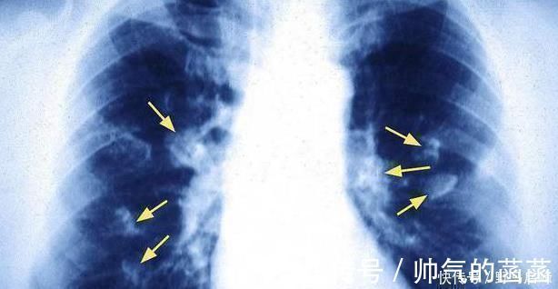 吸烟|肺癌一发现都是晚期错早期往往有蛛丝马迹,是身体在向你求救