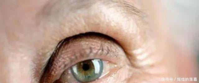 眼睛|做过双眼皮手术的年轻人,老了以后眼睛会怎么样看来是这个道理!