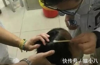 种病毒|爸爸帮女儿梳头,头皮上现白色“小球”,医生拔出后大开眼界